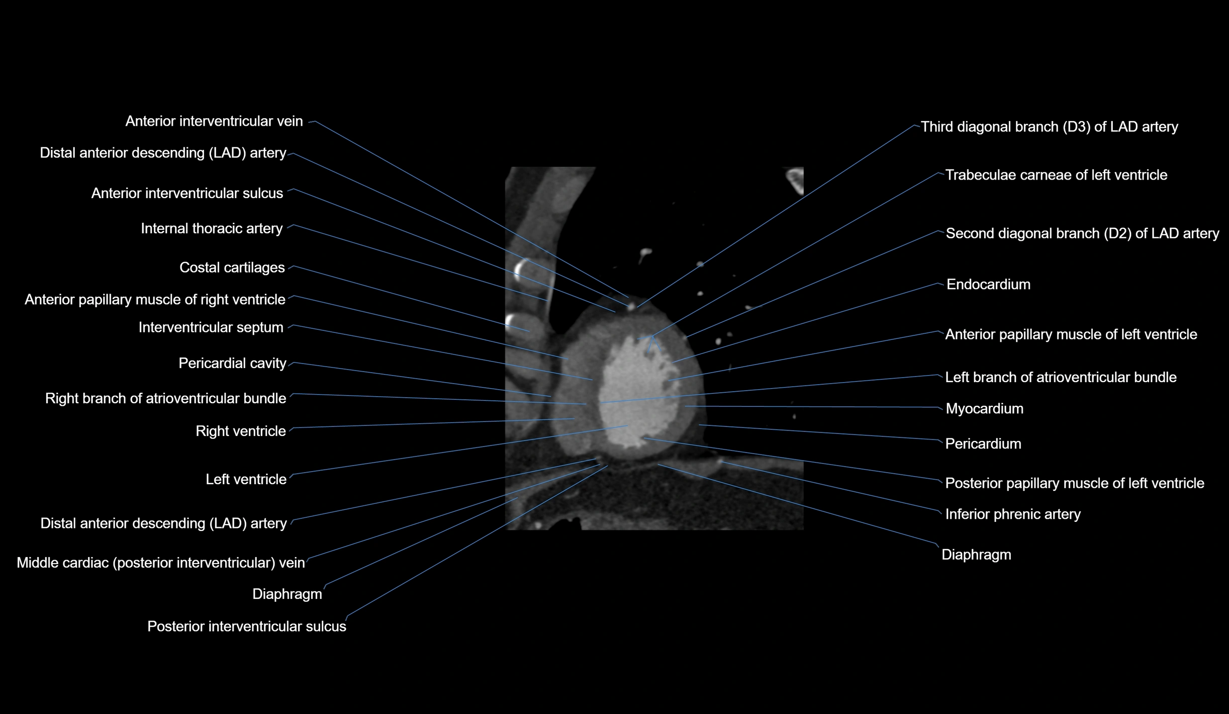 CT heart (coronary angiogram) short axis view  cross sectional anatomy labelled radiology image-00042.webp